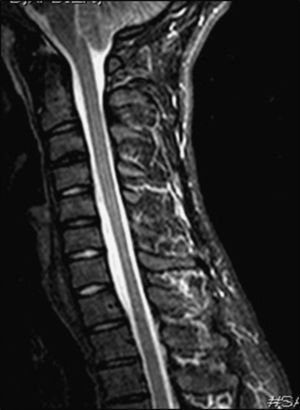 Patient 1. Cervical MRI scan in the neutral position (sagittal STIR) displaying slight spinal cord thinning at C6-C7 and moderate increase of the anterior subarachnoid space.