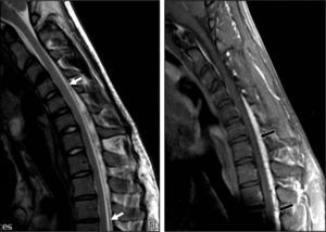 Patient 1. Flexion cervical MRI scan (T2 and T1) showing marked dura mater shifting from the posterior lamina (white arrows) and accumulation of liquid and engorgement of the posterior epidural venous plexus (black arrows). The spinal cord has moved forward and shows an angle at C6-C7.