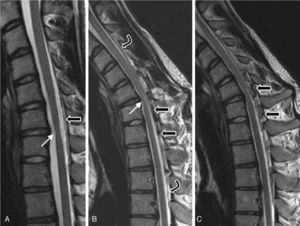 Patient 3. MRI scan performed in 2005 (T2). (A) Neutral position: moderate spinal cord atrophy at disc C6-C7 (white arrow) and minimal posterior detachment of the dura mater. (B) and (C) On flexion: anterior spinal cord compression at site of flexion (white arrow) and faint spinal cord hyperintensity; dura mater detachment (between curved arrows); accumulation of liquids in the epidural space, with signal voids suggestive of venous dilation (black arrows).