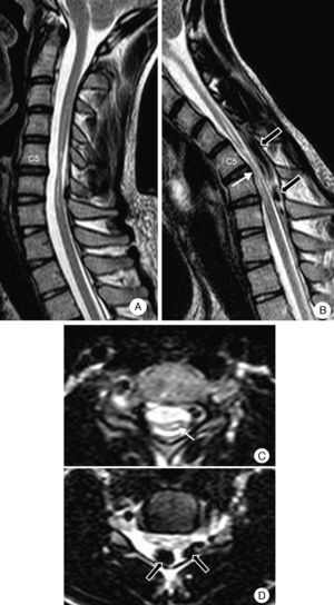 Patient 4. Cervical MRI scan. (A) Neutral position: severe atrophy at C5-C6 with spinal cord hyperintensity. (B) On flexion: the spinal cord presses against the edges of the vertebrae in the segment displaying the most atrophy (white arrow). Migration of the dura mater away from the posterior lamina and signal voids caused by venous engorgement (black arrows). (C) Neutral position (axial T2): severe asymmetrical predominantly right-sided atrophy, and hyperintensity compatible with spinal cord compression (arrow). (D) On flexion (axial T2): spinal cord pressing against a vertebra and large dilated epidural veins (black arrows).