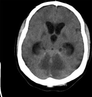 Head CT. Diffuse hypodensities in both cerebellar hemispheres with low attenuation in basal temporal white matter bilaterally and in basal ganglia. Dilated lateral ventricles and third ventricle.