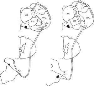 Diagram of the lateral (left) and medial (right) pain systems. The lateral system is represented by the lateral spinothalamic tract which has a sensory relay at the ventral posterolateral nucleus of the thalamus (left). The medial system relays sensory information by means of the medial spinothalamic tract, which ends at the midline and intralaminar thalamic nucleus. The thalamic centrolateral nucleus is shown in the figure (right). Thalamic connections between the two systems are scarce and shown on the left (dotted lines). Injury to these connections gives rise to thalamic pain syndromes.