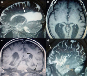 Head MRI scan of case 2. a) T2-weighted sagittal sequence. We can observe a great difference in size between the normal anterior horn of the lateral ventricle and the very enlarged portion (from the arrow onwards) in the occipital region. b) T1-weighted axial slice. View of the third ventricle with an arrow indicating the thin genu of the corpus callosum. c) T1-weighted coronal slice. The splenium of the corpus callosum (arrow) is shown crossing the midline at the posterior fossa level (dotted arrow over the cerebellar tentorium). d) T2-weighted sagittal slice: Frontal and occipital cortical sulci show similar degrees of dilatation, unlike in case 1.