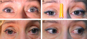 Clinical examination: light-near dissociation. a) Anisocoria due to mydriatic right eye. b) Intact near-response (tonic response in the RE). c) Response to instillation of 0.125% pilocarpine (RE, mydriasis caused by cholinergic denervation supersensitivity; LE, intact). d) No miosis with RE adduction (aberrant reinnervation of the OMN is ruled out).