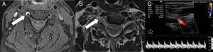 Neck MRI axial images (A, B): fat saturated T1-weighted sequence (A) showing a hyperintense signal surrounding the right vertebral artery at the C5 level (arrow), which is compatible with intramural haematoma. The T1-weighted sequence (B) shows compression of the C5 root (arrow) due to expansion of the haematoma. Colour Doppler ultrasound of the extracranial portion of the right vertebral artery (C) shows a biphasic flow in the V2 segment and increased pulsatility. No flow is observed in segment V1.