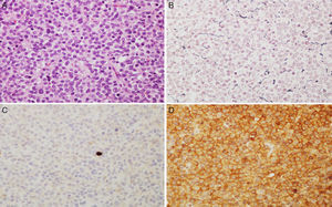 Microscopic images of a typical GH-positive pituitary adenoma. (A) Sheet-like proliferation of monomorphic cells with round or oval nuclei and a moderate amount of eosinophilic cytoplasm (haematoxylin–eosin stain, 200×). (B) The histological technique of reticulin staining demonstrates disruption of the normal acinar pattern of the anterior pituitary (Gomori reticulin stain 200×). (C) The cell proliferation index is low (Ki67<1%, 200×). (D) The adenoma shows strong cytoplasmic immunoreactivity for GH (GH, 200×).