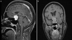 Preoperative T1-weighted MRI after contrast (A, sagittal; B, coronal); images from a patient with atypical macroadenoma, Knosp grade 4. Note the tumour's propensity for suprasellar extension, with bilateral extension to the cavernous sinus, erosion of the dorsum sellae, and hydrocephalus secondary to the tumour.