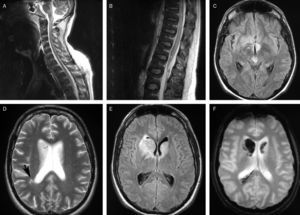 MR images. (A) and (B) Sagittal T2-weighted sequences displaying hyperintense lesions in the spinal cord and brainstem. (C) Axial FLAIR sequence showing hyperintense lesions in the mesencephalic tegmentum and the hypothalamic region. (D) Axial T2-weighted sequence showing increased signal in both caudate nuclei and subcortical white matter. (E) Axial FLAIR T2-weighted sequence exhibiting lesions in both caudate nuclei. (F) Axial T2-weighted gradient echo sequence showing a hypointense signal in the caudate nucleus, which suggests a haemorrhagic component.