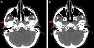 (A and B) CT images. The arrow points to the affected area.