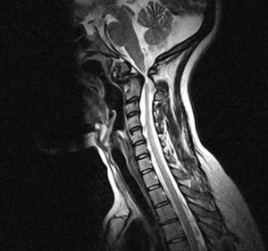 Cervical MR image showing compression of the spinal cord at the cervicomedullary junction.