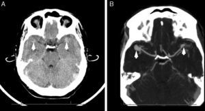 (A) The CT scan (axial slice) shows foci of subarachnoid haemorrhage with an aneurysmal pattern in both Sylvian fissures (more marked on the left side). Areas of increased focal density with pseudonodular morphology may be seen in both MCAs, suggesting either a haemorrhagic component or aneurysms (arrowheads). (B) Intracranial CT angiography showing the circle of Willis (axial slice): 2 saccular aneurysms can be seen in the MCAs (arrowheads). An aneurysm measuring 11mm×9mm with a 5-mm neck can be seen in the right MCA (at M2 bifurcation). An aneurysm measuring 8mm×4.5mm with a neck of 1 to 2mm can be seen in the left MCA (also in the most distal portion of the M2 segment).