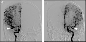 (A) A digital subtraction angiography (anteroposterior projection) with selective contrast injection into the right internal carotid artery confirms the presence of an unruptured aneurysm in the M2 segment of the right MCA (arrowhead). (B) A digital subtraction angiography (anteroposterior projection) with selective contrast injection into the left internal carotid artery reveals the presence of an aneurysm in the M2 segment of the left MCA (arrowhead). The aneurysm has irregular lobulated contours suggesting a rupture, which points to this aneurysm being the one responsible for the SAH.