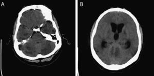 (A) Diffuse hypodensity in both cerebellar hemispheres, basal temporal white matter bilaterally, both internal capsules, and the globus pallidus. (B) Severe dilation of the lateral ventricles and third ventricle (the fourth ventricle was normal), which results in severe mass effect leading to effacement of the convexity sulci and a decrease in the size of the basal cisterns.