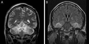 Multiple early subacute cerebral lesions which extensively affect the limbic system, as well as extensive infarcts throughout the cerebellar hemispheres.