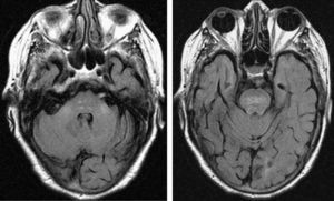 T2-weighted FLAIR MRI scan. Hyperintensities can be observed in the pons and middle cerebellar peduncles.