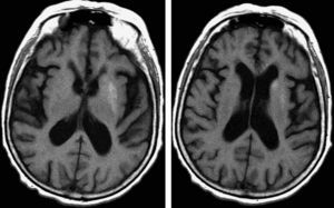 T1-weighted fast-spin echo MRI scan. The left caudate and lentiform nuclei show hyperintensities.