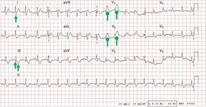 Electrocardiogram (ECG) showing sinus tachycardia at 120bpm, right axis deviation, S1Q3T3 pattern (pointed arrows), and complete right bundle branch block (rounded arrows). All of these findings were new.