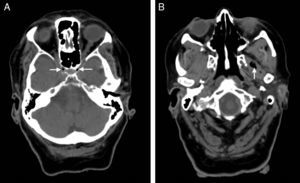 A simple axial CT scan performed 50minutes after symptom onset revealed air bubbles (arrow heads) inside both cavernous sinuses in the parasellar region (A) and at the level of the left lateral pterygoid muscle (B), adjacent to the trajectory of both internal carotid arteries, which exhibit signs of intracavernous atheromatous calcification.