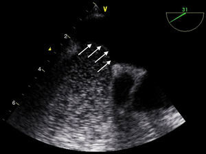 A transoesophageal echocardiogram was performed 24hours after symptom onset. Spontaneous echo contrast was not seen even during the Valsalva manoeuvre. The image reveals a protrusion of the interatrial septum (indicative of increased pressure in the right cardiac cavities; arrows), but no interatrial connection or air bubbles (probably dissolved in the systemic circulation).