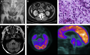 (A) Simple radiography of the pelvis: osteosclerosis on the diaphysis and epiphysis of both femurs and the pubic bone. (B) Abdominal CT scan: infiltrating perirenal mass showing increased uptake. (C) Haematoxylin–eosin stain: histiocytic infiltrate with abundant clear to foamy cytoplasm. (D) Brain MRI, FLAIR axial sequence at 9 months: signal alterations in the pons and spreading towards the middle cerebellar peduncles. (E) 18F-FDG PET-CT scan: ring-shaped uptake pattern in the pons showing hypometabolic activity at the centre and moderate peripheral activity.