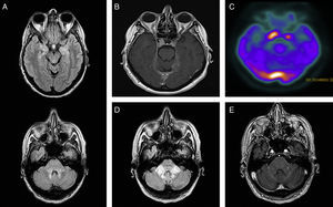 (A) Brain MRI, FLAIR axial sequence: hyperintensities in the middle cerebellar peduncles, dorsal pons, mesencephalic periaqueductal grey, and uncus. (B) Brain MRI, T1-weighted axial sequence with gadolinium: contrast-enhanced bilateral parasellar lesions, larger on the right side, and in the torcula and bilateral tentorium cerebelli. (C) 18F-FDG PET/CT: increased uptake in the area of the pituitary gland and the torcula. (D) Brain MRI, FLAIR axial sequence at 18 months: signal alterations at the level of the middle cerebellar peduncles. (E) Brain MRI, T1-weighted axial sequence with gadolinium: nodular contrast enhancement at the level of the middle cerebellar peduncles.