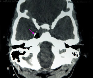 Non-contrast cranial CT scan showing a heterogeneous area about 14mm in diameter in the cavernous sinus, with fat density and benign-looking soft tissue, surrounded by a ‘bone shell’ (arrow).
