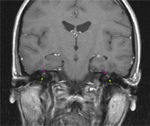 Brain MRI (coronal T1-weighted image) with gadolinium. Hyperintense micronodules associated with chemical shift artefacts (fat) in both internal auditory canals (upper arrows). Increased uptake in the first segment of the right facial nerve (intracanalicular) and the second segment of the left facial nerve (labyrinthine) (lower arrows).