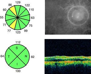 Quantitative analysis of RNFL thickness in a patient who experienced an episode of optic neuritis in the right eye more than 6 months previously. Thickness in all clock-hour sectors and quadrants is expressed in microns.