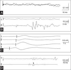 (A) Absent somatosensory evoked potentials in the internal pudendal nerve. (B) Registered transcranial magnetic stimulation of the bulbocavernosus muscle in relaxed state (1) and after motor facilitation (2) showed normal latency. (C) Sympathetic skin response to nociceptive stimulation of the right sole (1), the left sole (2), the right palm (3), and the perineum (4). (D) Right (1) and left (2) bulbocavernosus reflex with normal latency and symmetry.