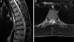Axial (A) and transversal (B) T2-weighted MRI sequences of the dorsal column showing hyperintensities in the centre of the spinal cord at T5-T6 and no mass effect, uptake, or oedema, which is compatible with residual signs of myelomalacia.