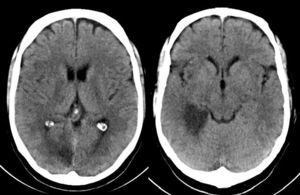 Brain CT. Hypodensity in the territory of the dorsolateral and temporoccipital thalamoperforating branches of the right posterior cerebral artery.
