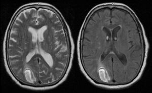 Brain MRI. The periphery of the lesion is hyperintense in T2-weighted and FLAIR sequences, a finding compatible with intraparenchymal haemorrhage in the right occipital cortical–subcortical area.