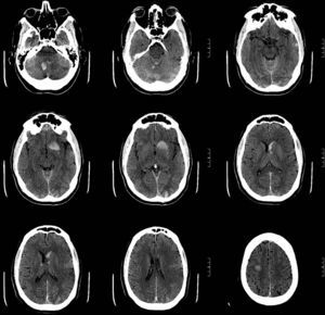 Simple cranial CT, axial sequences showing multiple haemorrhagic foci.