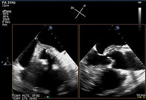 Transoesophageal echocardiography revealed periaortic abscess.