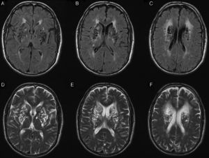 Brain MRI: axial FLAIR (A-C) and T2-weighted (D-F) sequences showing multiple dilated perivascular spaces predominantly in the basal ganglia bilaterally.