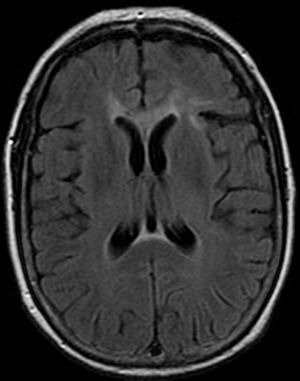 MRI FLAIR sequence (axial slice) showing anomalies in the genu and splenium of the corpus callosum.