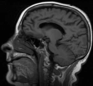 MRI FLAIR sequence (sagittal slice) showing diffuse and extensive necrosis of the entire corpus callosum.
