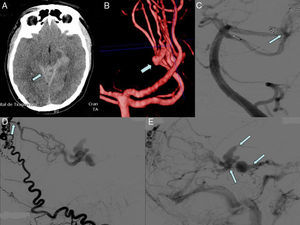 (A) Cranial CT scan: subarachnoid haemorrhage at symptom onset. (B) 3D reconstruction based on CT: flow-related aneurysm in the left external carotid artery. (C) Aneurysm embolisation. (D) Angiography: arterial supply from the meningeal branches of the external carotid artery; the point where the occipital artery becomes intracranial can be seen. (E) Angiography: thick drainage veins with blood flow inversion and draining to the straight sinus.