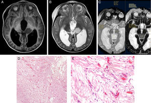 Low-grade tumour (pilocytic astrocytoma): (A) T1-weighted sequence; (B) T2-weighted sequence; (C) ADC map; (D) haematoxylin–eosin stain (4×); (E) haematoxylin–eosin stain (40×).
