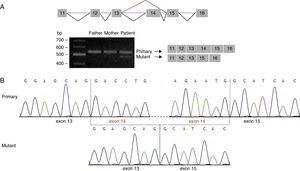 Analysis of the mutation c.1249+2T>C by cDNA sequencing. (A) Amplification of the cDNA region corresponding to exons 11 to 16 of STXBP1 showed 2 different amplicon sizes in our patient: a band of 559bp (also seen in the patient