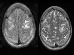MRI gadolinium-enhanced T1-weighted sequences showing a hypointense lesion in the left frontal cortex with no contrast uptake.