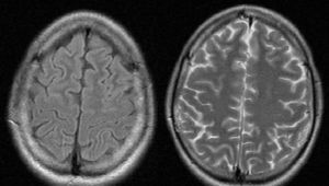 MRI T2-weighted sequences revealing hyperintense lesions in the frontal cortex bilaterally which were more pronounced on the left side.