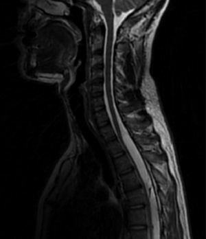 Sagittal cervical-lumbar T2 weighted MRI sequence showing an arachnoid cyst extending from T1 to T9.