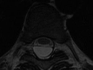 Axial dorsal MRI of an extradural arachnoid cyst.