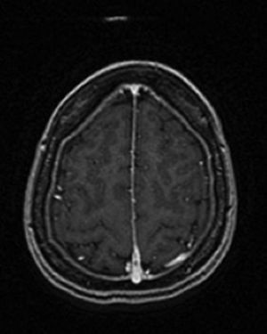 T1 hyperintensity (Ax FSE T1+GD) in a left parietal superior cortical vein at the level of the parasagittal convexity, compatible with cortical venous thrombosis.