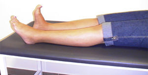 Dystonic-like posturing of the left lower limb. Note that the left foot is unable to perform dorsiflexion, unlike the right foot.