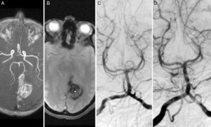 Brain MRI. (A) Intracranial arteries in 3D sequences. (B) Axial T2* sequence showing an intraparenchymal haematoma in the left parieto-occipital region (T2* in A and B). Digital subtraction angiography: (C and D) Anteroposterior view showing a saccular aneurysm measuring 3mm in the P4 segment of the left PCA (calcarine artery), before (white arrow in C) and after coiling (white arrow in D).