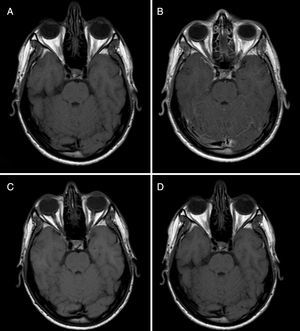 Baseline and follow-up MRI scans (before and after gadolinium administration). The comparison between baseline MR images before (A) and after (B) gadolinium administration reveals slight leptomeningeal enhancement in the superior and vermis folia. Three-month follow-up MR images before (C) and after (D) gadolinium administration evidence resolution of leptomeningeal enhancement.