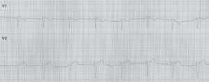 ECG leads V1-V2 showing a QRS complex with an RSR’ pattern in V1 and coved ST segment elevation in V2.