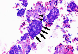 Cytology test of bloody pleural fluid. Cell block (haematoxylin–eosin stain) showing tumour cells (nuclear moulding with an extremely high nuclear–cytoplasmic ratio, abundant mitotic figures, and minimal cytoplasm) (arrows) intermingled with reactive mesothelial cells (more abundant, eosinophilic cytoplasm, light pink in colour) (arrowheads). The immunohistochemical study of tumour cells was positive for thyroid transcription factor 1 (TTF-1, which points to a primary pulmonary origin), chromogranin/synaptophysin, CD56, and Ki-67 (MIB-1) (in 57% of all neoplastic cells). These findings were compatible with infiltration or metastasis of small-cell neuroendocrine carcinoma of the lung.